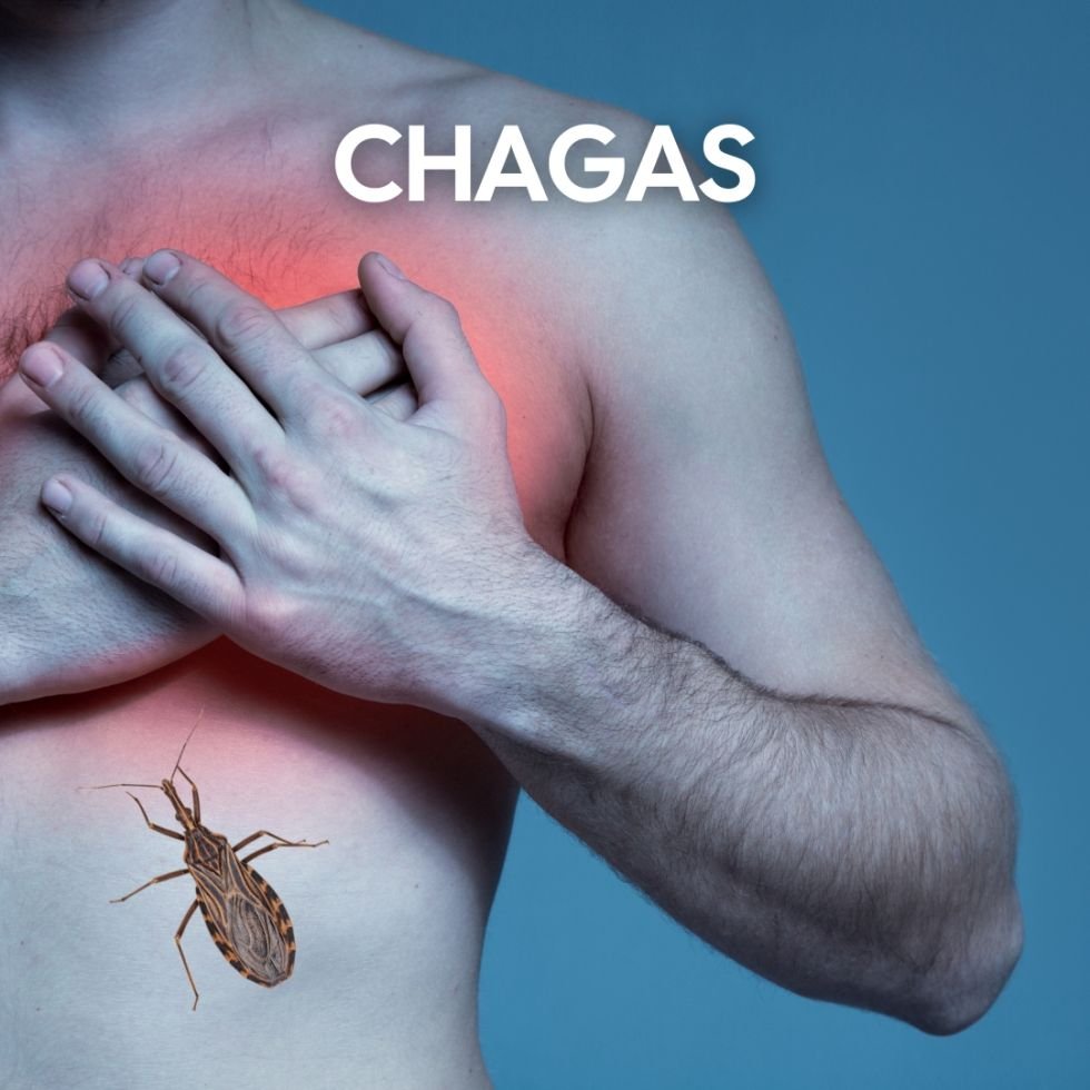 Síntomas del Chagas